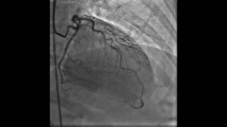 Coronary Angiogram of Myocardial Bridging [upl. by Iiette]