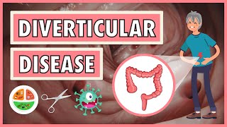 Diverticular Disease  Emphasis on DietNutrition [upl. by Profant695]