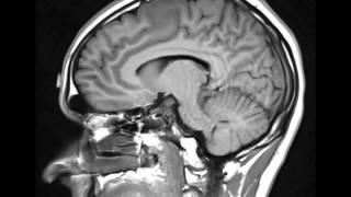 Lowgrade Astrocytoma [upl. by Lalittah]