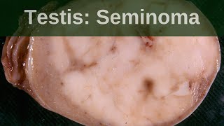 Testicular germ cell tumours  Seminoma  Pathology mini tutorial [upl. by Zile]