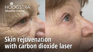 Skin rejuvenation with carbon dioxide laser  24088 [upl. by Anirtep]