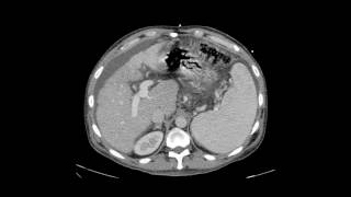 Transjugular Intrahepatic Portosystemic Shunt TIPS [upl. by Blainey]