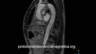 AORTA CIV SAG OBL [upl. by Moriah]