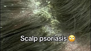 Scalp Psoriasis Removal [upl. by Mina]