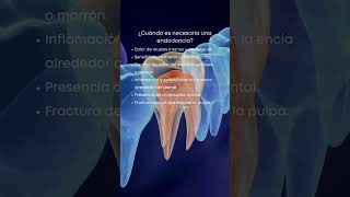 Endodoncia ¿cuándo es necesario realizarla [upl. by Oreste473]