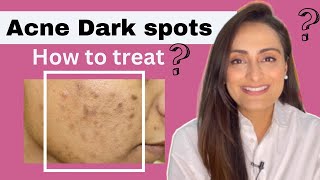 Acne Dark Spots  हिंदी  How to treat  serum cream recommendations  Dermatologist  Dr Aanchal [upl. by Milas26]