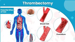 Endovascular thrombectomy  is a invasive surgical procedure treat acute ischemic stroke [upl. by Erbua537]