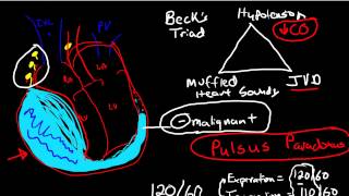 Oncologic Emergencies Cardiac Tamponade [upl. by Atikahs]