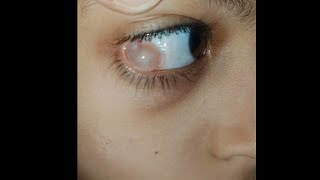 Hidden Swelling in eyes 👀  condition explained indetail eyecareoptom5506 eye eyelid swelling [upl. by Fifine]