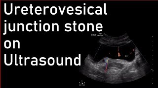 Ureterovesical junction stone on Ultrasound [upl. by Grimes]