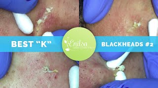 quotKsquot Best Blackhead Extraction Compilation Part 2 [upl. by Deck814]