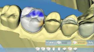 CEREC SW 40 Overview from Beta Testers [upl. by Anstice392]