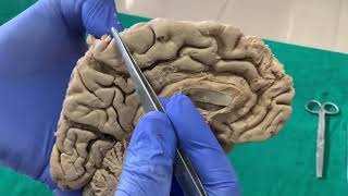 Dissection Sulci amp Gyri on Medial surface of brain [upl. by Youngman]