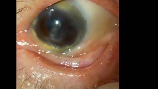 Ocular Cicatricial Pemphigoid [upl. by Euphemiah225]