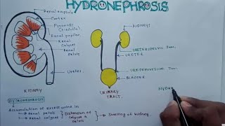 HYDRONEPHROSIS  Pathophysiology Causes signs and symptoms background diagnosis and treatment [upl. by Jo-Ann274]