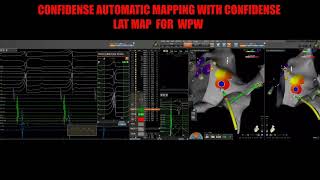 wpw ablation  AUTOMATIC MAPPING [upl. by Sofko819]