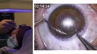 London Vision Clinic  ReLEx SMILE  Live laser eye surgery  Professor Dan Reinstein [upl. by Ssilb]