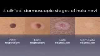 Halo Nevus  White Circles On Skin TREATMENT [upl. by Aititil918]