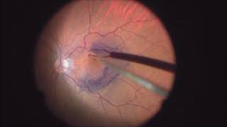 Why to dye an epiretinal membrane twice [upl. by Eyot]