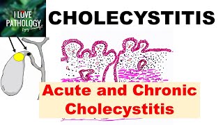 CHOLECYSTITIS Acute and Chronic Pathology and Complications [upl. by Oniotna]