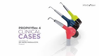 Case Studies for the KaVo PROPHYflex 4 air polishing device  UK [upl. by Glialentn]