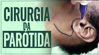 Cirurgia da Parótida  Tudo o que você precisa saber [upl. by Joann900]