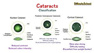 TYPES OF CATARACT  CORTICAL VS NUCLEAR VS POSTERIOR SUBCAPSULAR [upl. by Muslim]