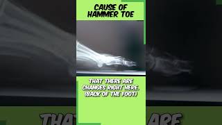 Is Your Foot Pain Caused by Hammer Toe hammertoes [upl. by Emixam]