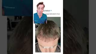 Hair Transplant Recovery Timeline [upl. by Quintessa]