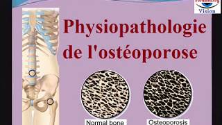 Physiopathologie de losteoporose fragilité osseuse osteopathie du dos cours de rhumatologie [upl. by Gotcher]