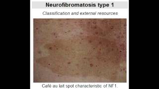 Neurofibromatosis Type 1 von Recklinghausens Disease [upl. by Eduam]