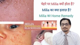 Milia Treatment  Whiteheads  Milia का इलाज  milia treatment at home  milia removal cream milia [upl. by Arhoz]