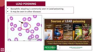 Hematology  1  U8L5  Lead poisoning [upl. by Enyluqcaj]