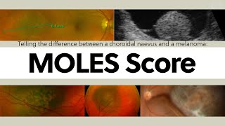 Telling the difference between a choroidal naevus and a melanoma The MOLES Score  OT Skills Guide [upl. by Bayless]