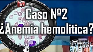 Caso clinico Nº2 ¿Anemia hemolitica [upl. by Kooima]