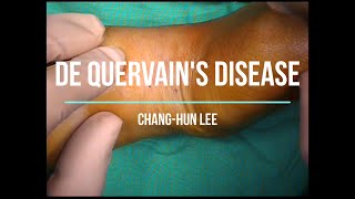 손목 건초염 수술 영상 드꿰르벵병 de Quervains disease [upl. by Billi]