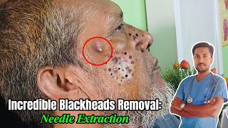 7YearOld Giant Blackhead Extraction Needle Method Revealed  alliedhealthscience skincare [upl. by Alial961]