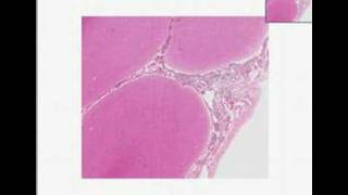 Histopathology Brain Acute pyogenic bacterial meningitis [upl. by Alhak198]