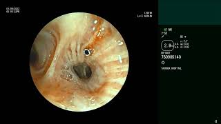 EBUS Needle Fracture  Bronchoscopic retrievel [upl. by Therron]