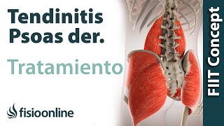 Tratamiento de la tendinitis del psoas derecho o psoitis derecha [upl. by Niffirg]