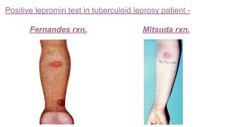 Lepromin test pathology mbbs [upl. by Oeram756]