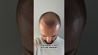 Scab removal after 10 days FUE hair transplant [upl. by Ymirej441]