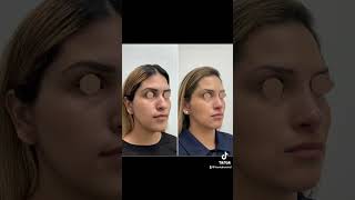 Non Surgical Rhinoplasty Dr Hannah Vu MD Skinzone Medical [upl. by Ailati]