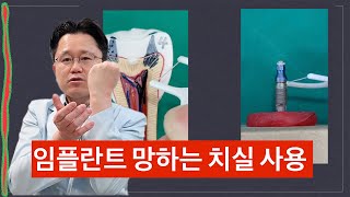 치실 잘못하면 임플란트 망하는 이유 추천 임플란트 칫솔 기구 설명 [upl. by Ellesirg]