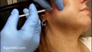 Watch Botox Facial Shaping and TMJRajani [upl. by Nel578]