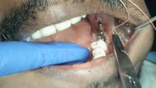 Live  grossly decayed molar  rootstumps 38 impaction  immediate loading basal implants [upl. by Dola533]