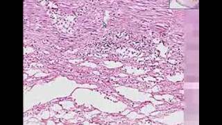 Histopathology ColonIschemic enterocolitis [upl. by Nylac]