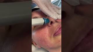 HydraFacial Vortex Fusion Facial [upl. by Attekram]