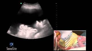 How To Ultrasound Guided Paracentesis Procedure 3D Video [upl. by Clary]