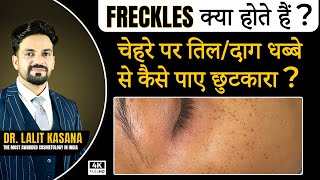 Freckles क्या होता हैं  चेहरे पर तिल दाग धब्बे से कैसे पाए छुटकारा  at Dr Kasana Clinic [upl. by Monreal]